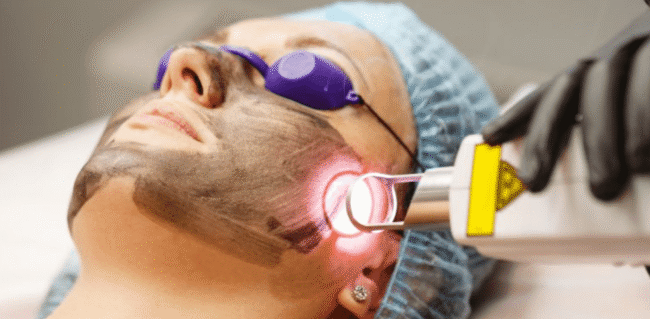 Carbon Peel Laser